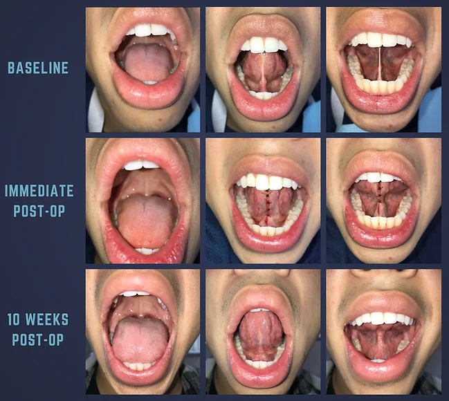 What is an oral tie? Oral tie treatment case study example