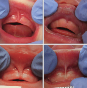 Oral Ties Mountain View Pediatric Dentistry What Is An Oral Tie