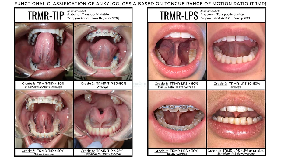 What is an oral tie? This TRMR TIP & LPS diagram will help explain